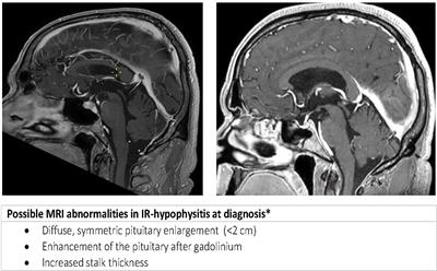 Differences in checkpoint-inhibitor-induced hypophysitis: mono- versus combination therapy induced hypophysitis